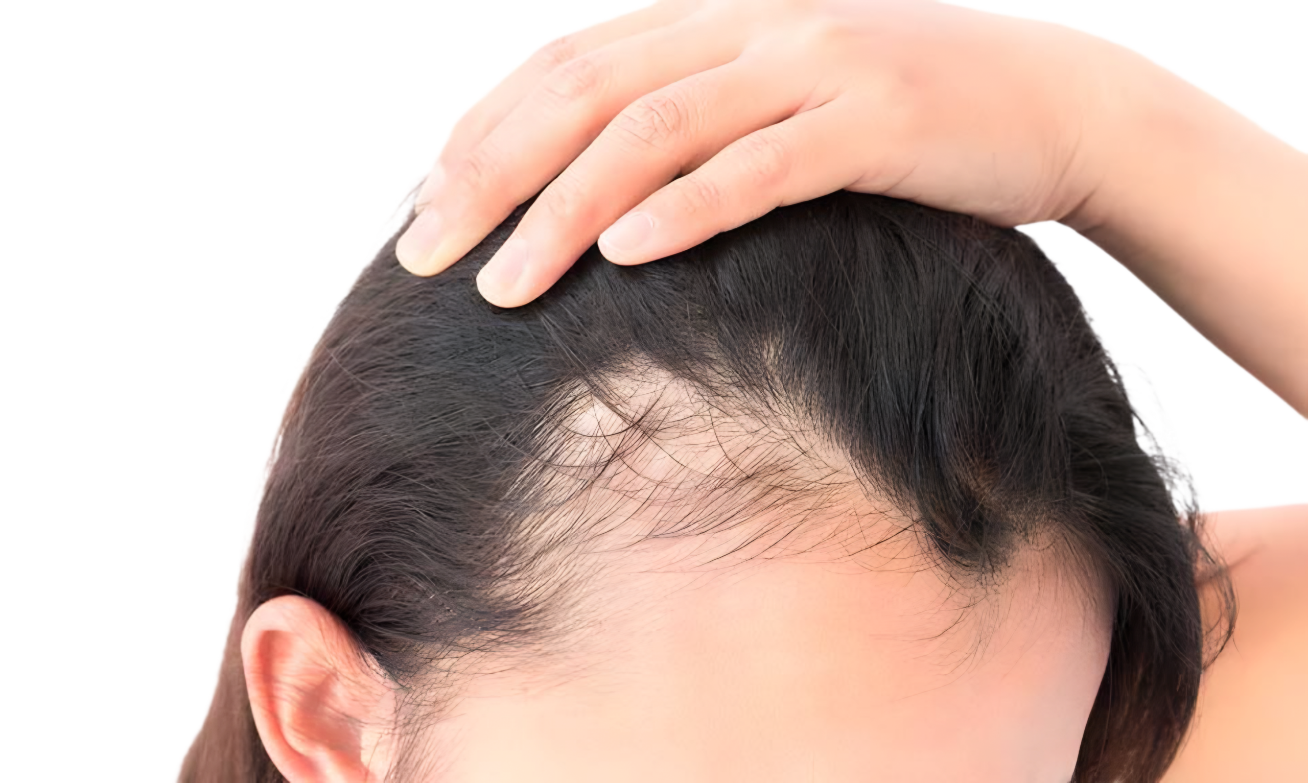 تساقط الشعر عند النساء